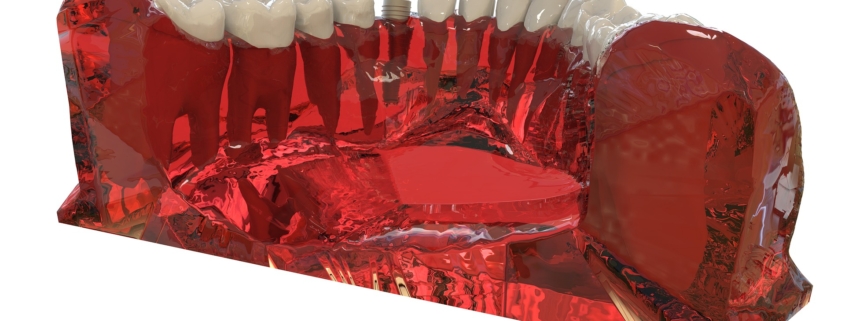 Kosten von Implantaten